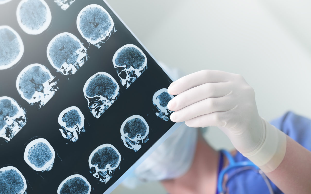 Aivohalvauksen Varoitusmerkit: Neurologi Paljastaa Oireet, Joita Ei Missään Nimessä Saa Sivuuttaa