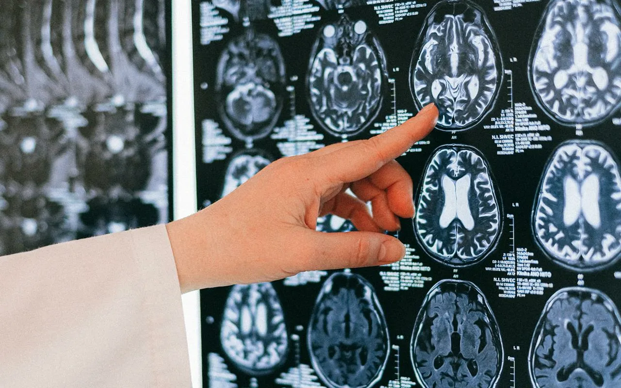 Aivohalvauksen Varoitusmerkit: Neurologi Paljastaa Oireet, Joita Ei Missään Nimessä Saa Sivuuttaa