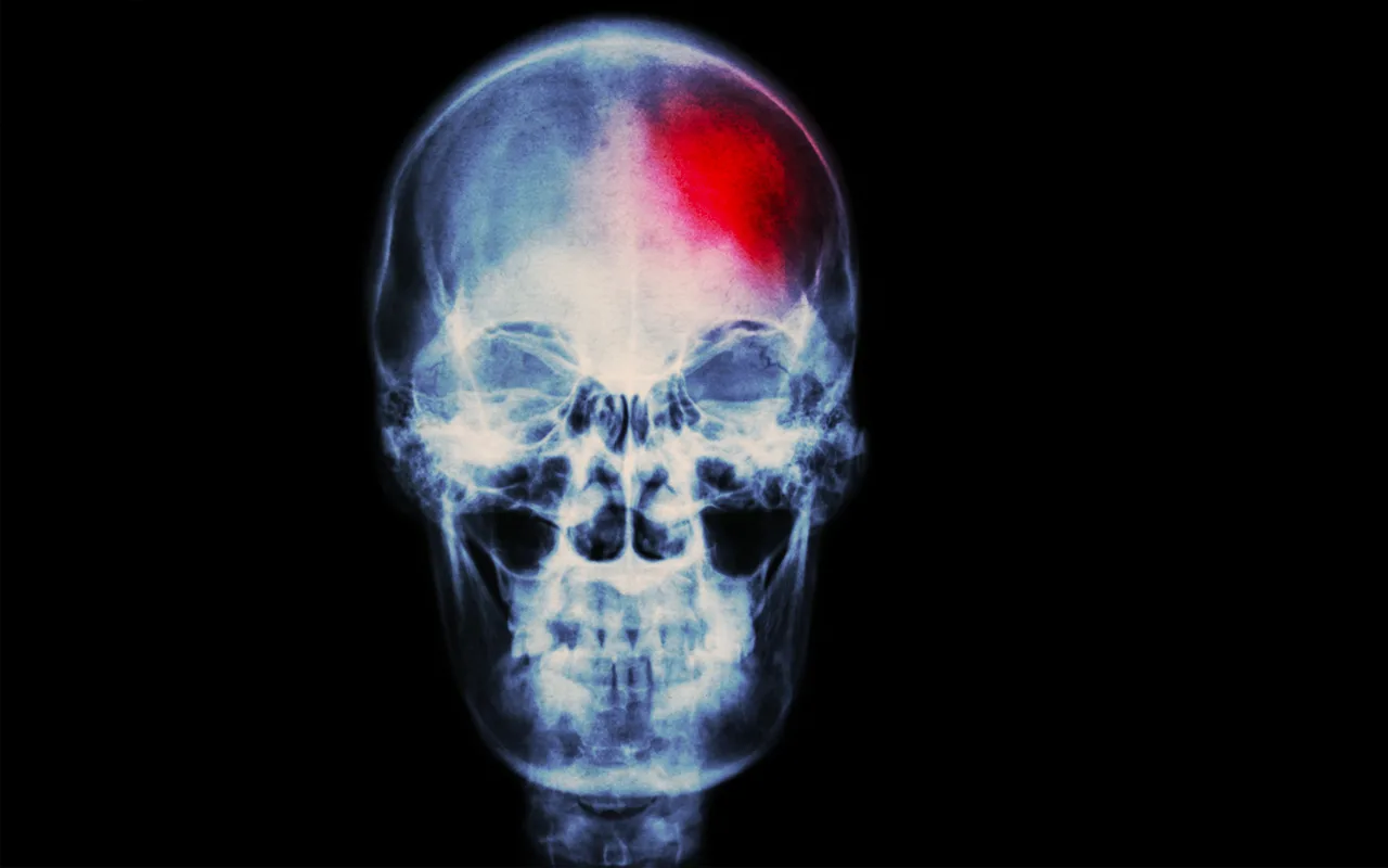 Tutkijat Testaavat Ultraäänikypärää, Joka Voi Muuttaa Parkinsonin Taudin Hoidon